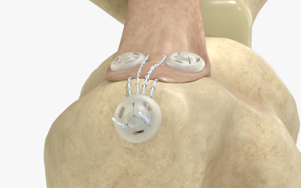 Ziptek® Knotless Tissue Repair Device.