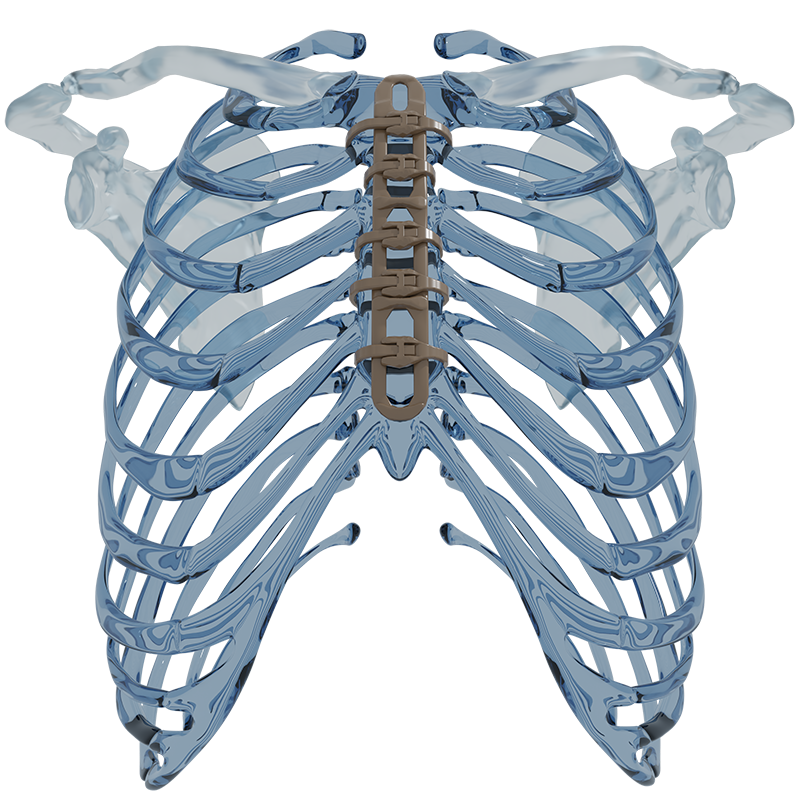 The VariTrax Sternal CircumFixator™ system